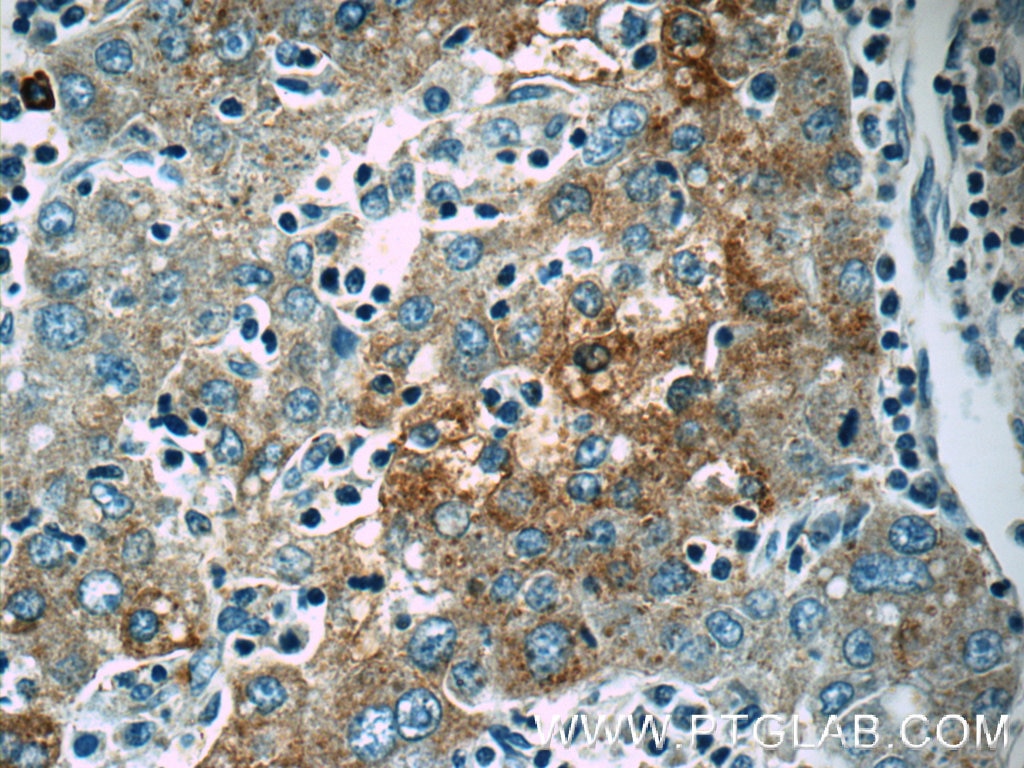 Immunohistochemistry (IHC) staining of human liver cancer tissue using Autotaxin Polyclonal antibody (14243-1-AP)