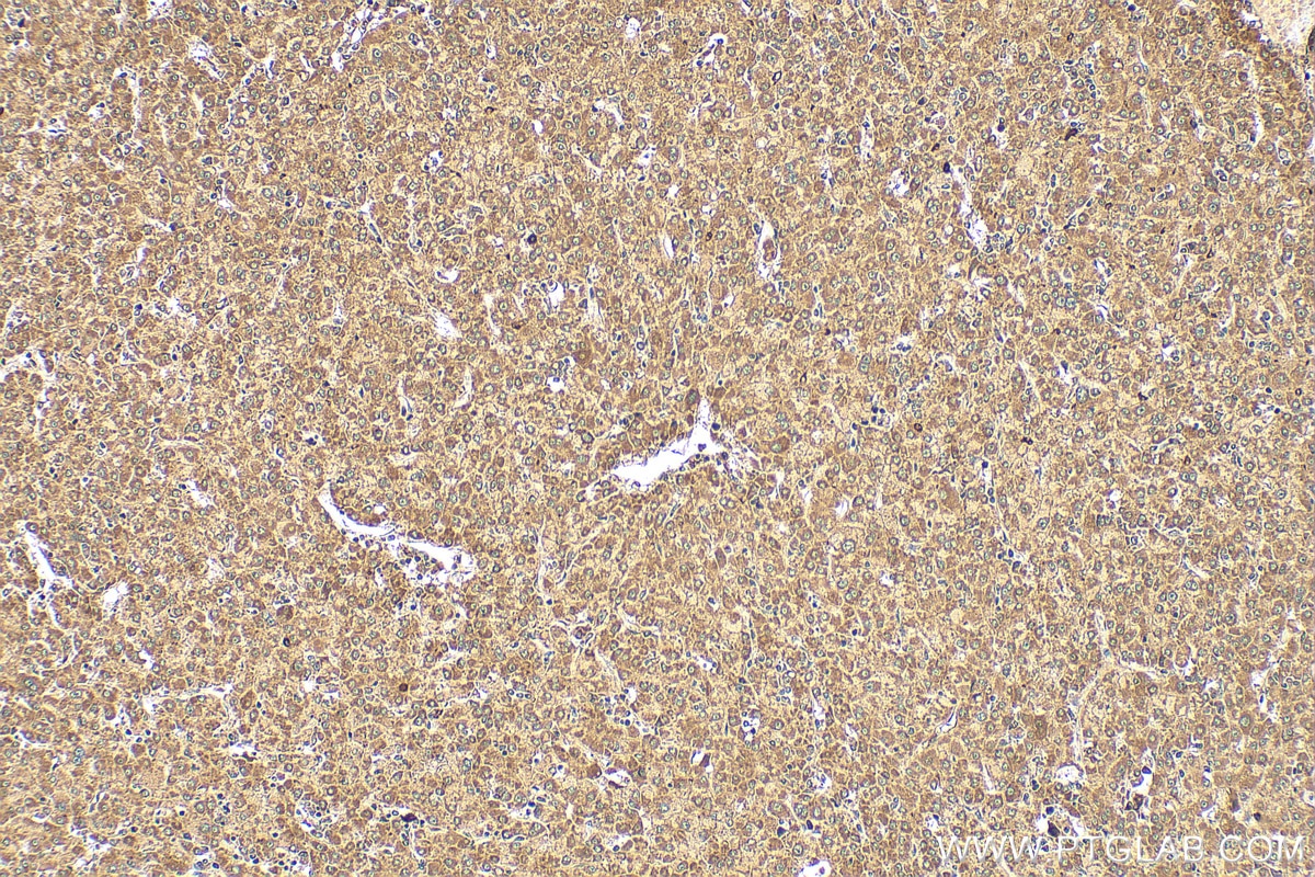 Immunohistochemistry (IHC) staining of human liver cancer tissue using ENPP2 Polyclonal antibody (14243-1-AP)