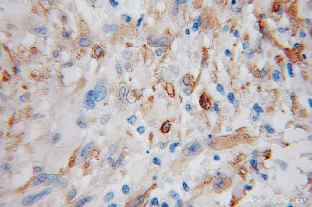 Immunohistochemistry (IHC) staining of human gliomas tissue using ENPP5 Polyclonal antibody (12778-1-AP)