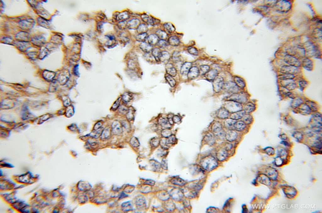 Immunohistochemistry (IHC) staining of human breast cancer tissue using ENT1 Polyclonal antibody (11337-1-AP)