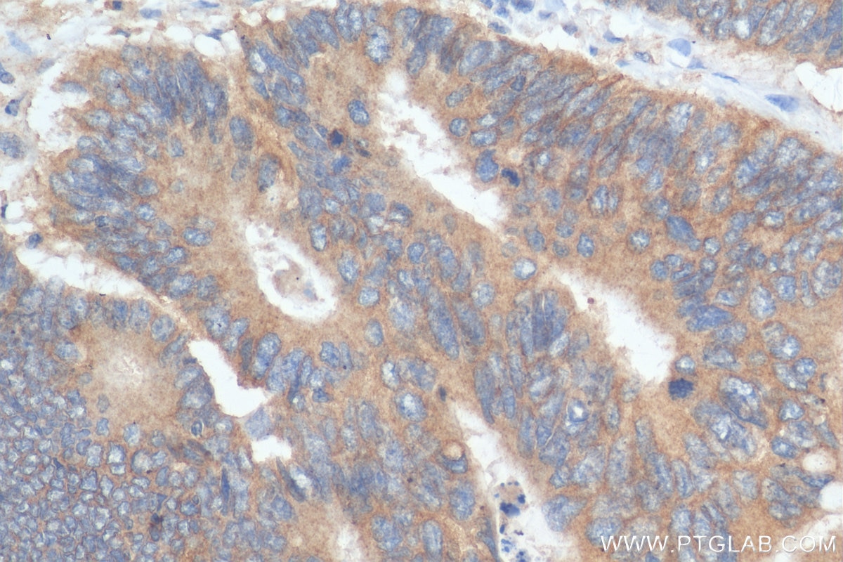 IHC staining of human colon cancer using 29862-1-AP