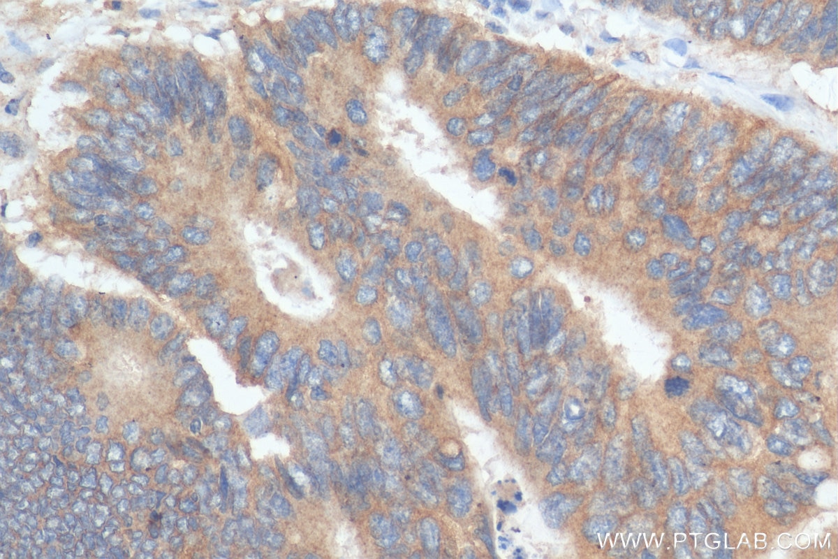 Immunohistochemistry (IHC) staining of human colon cancer tissue using ENT1 Polyclonal antibody (29862-1-AP)