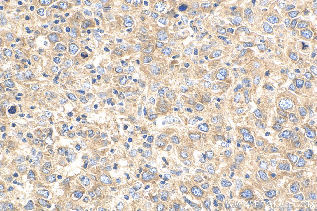 Immunohistochemistry (IHC) staining of human lymphoma tissue using ENT1 Polyclonal antibody (29862-1-AP)