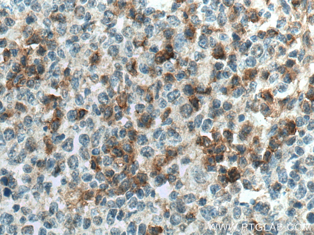 Immunohistochemistry (IHC) staining of human tonsillitis tissue using CD39/ENTPD1 Polyclonal antibody (14211-1-AP)