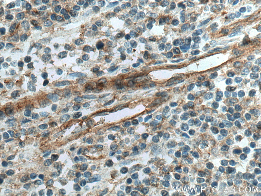 IHC staining of human tonsillitis using 14211-1-AP