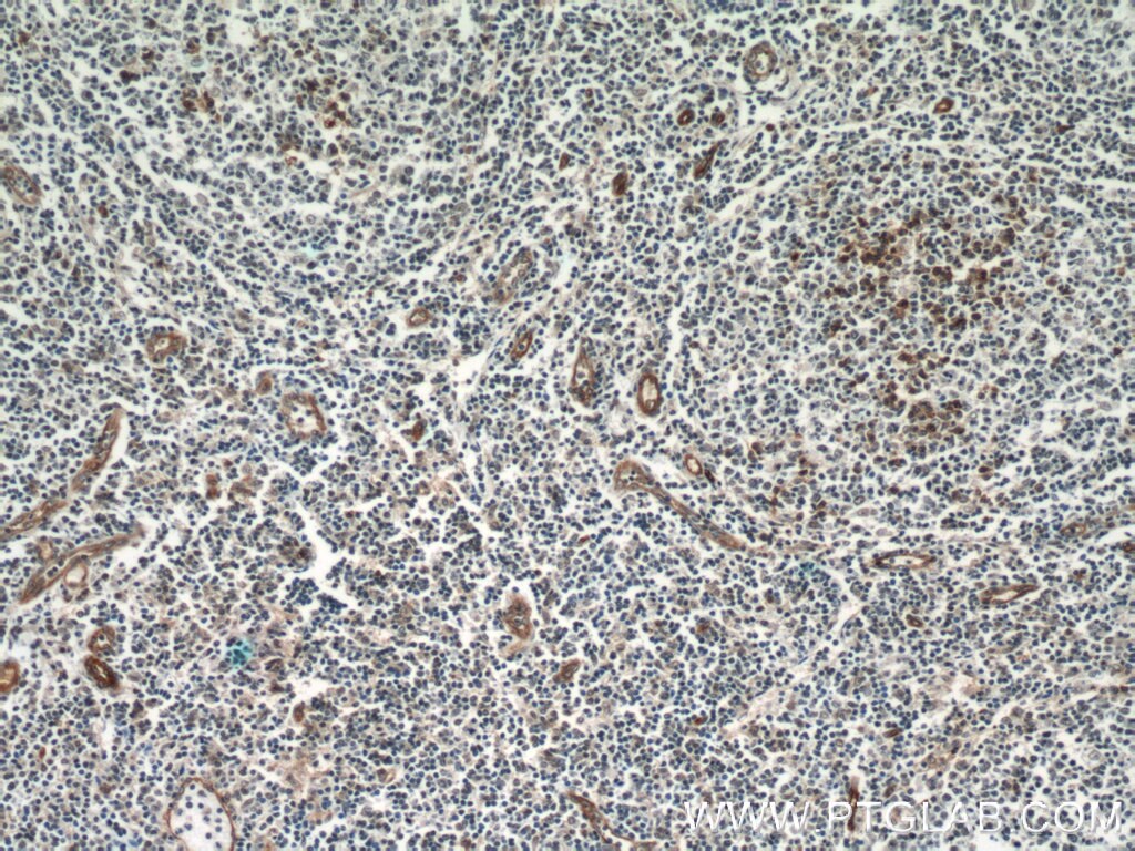 Immunohistochemistry (IHC) staining of human tonsillitis tissue using CD39/ENTPD1 Polyclonal antibody (19229-1-AP)