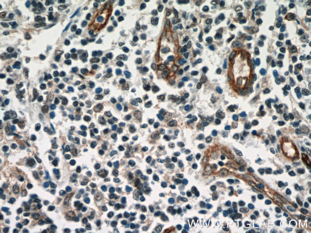Immunohistochemistry (IHC) staining of human tonsillitis tissue using CD39/ENTPD1 Polyclonal antibody (19229-1-AP)