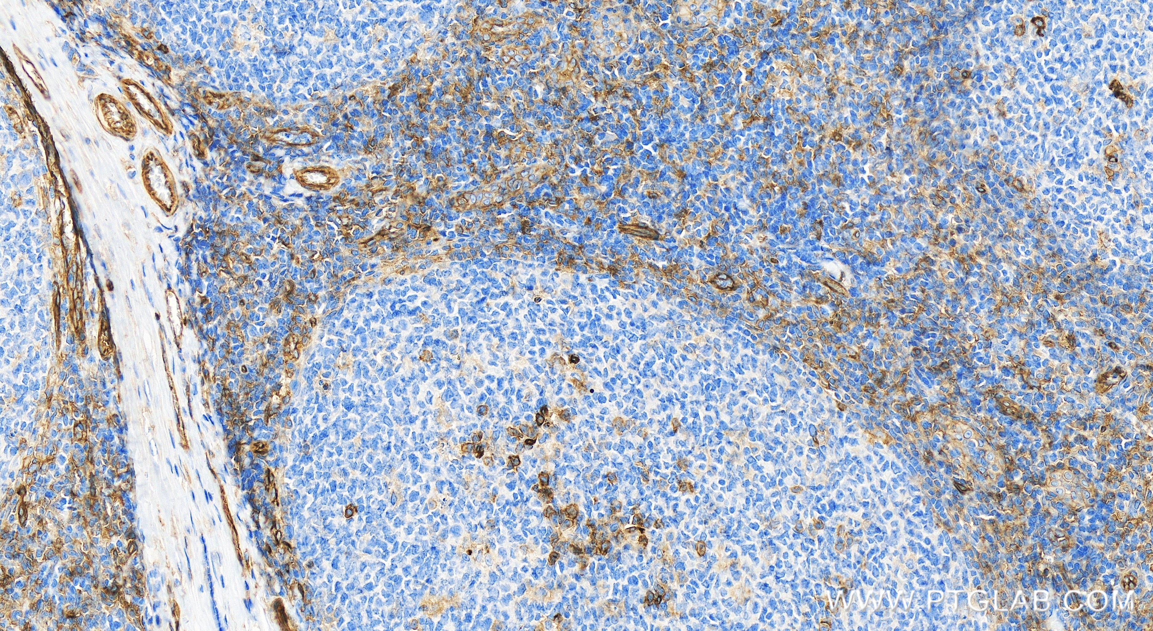 Immunohistochemistry (IHC) staining of human tonsillitis tissue using ENTPD1 Recombinant antibody (84235-4-RR)