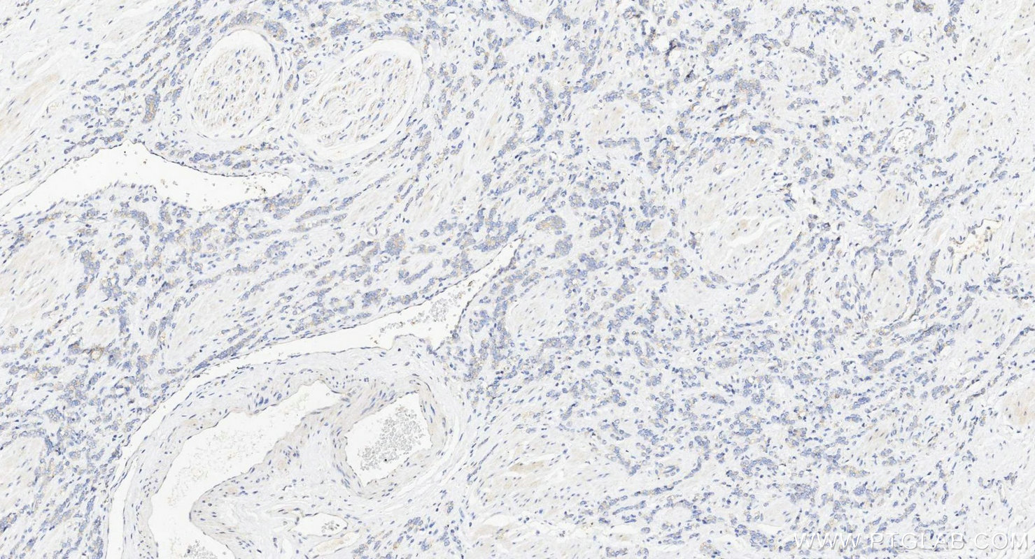 IHC staining of human prostate cancer using 11626-1-AP Immunohistochemistry (IHC) staining of human prostate cancer tissue using ENTPD6 Polyclonal antibody (11626-1-AP)