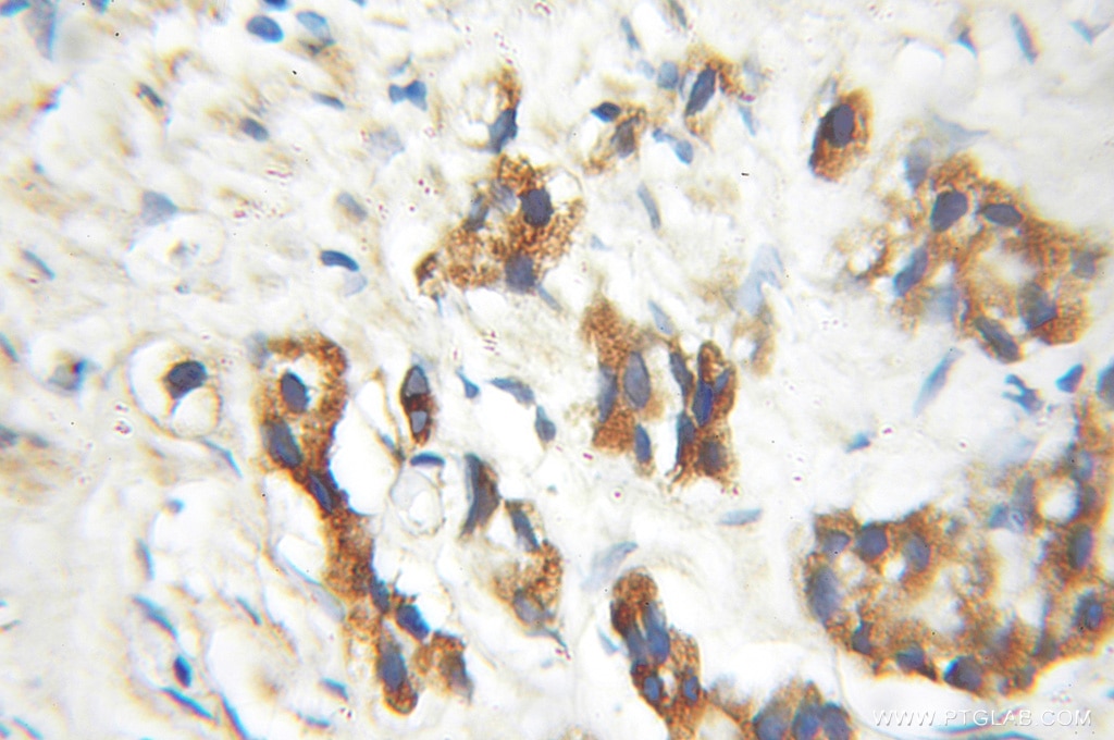 Immunohistochemistry (IHC) staining of human prostate cancer tissue using ENTPD6 Polyclonal antibody (11626-1-AP)