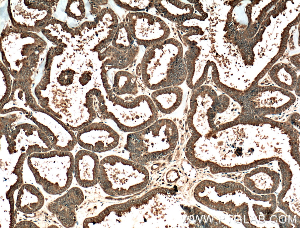IHC staining of human ovary tumor using 24558-1-AP