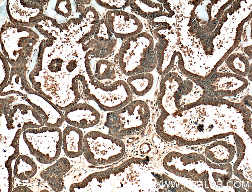 Immunohistochemistry (IHC) staining of human ovary tumor tissue using ENTPD7 Polyclonal antibody (24558-1-AP)