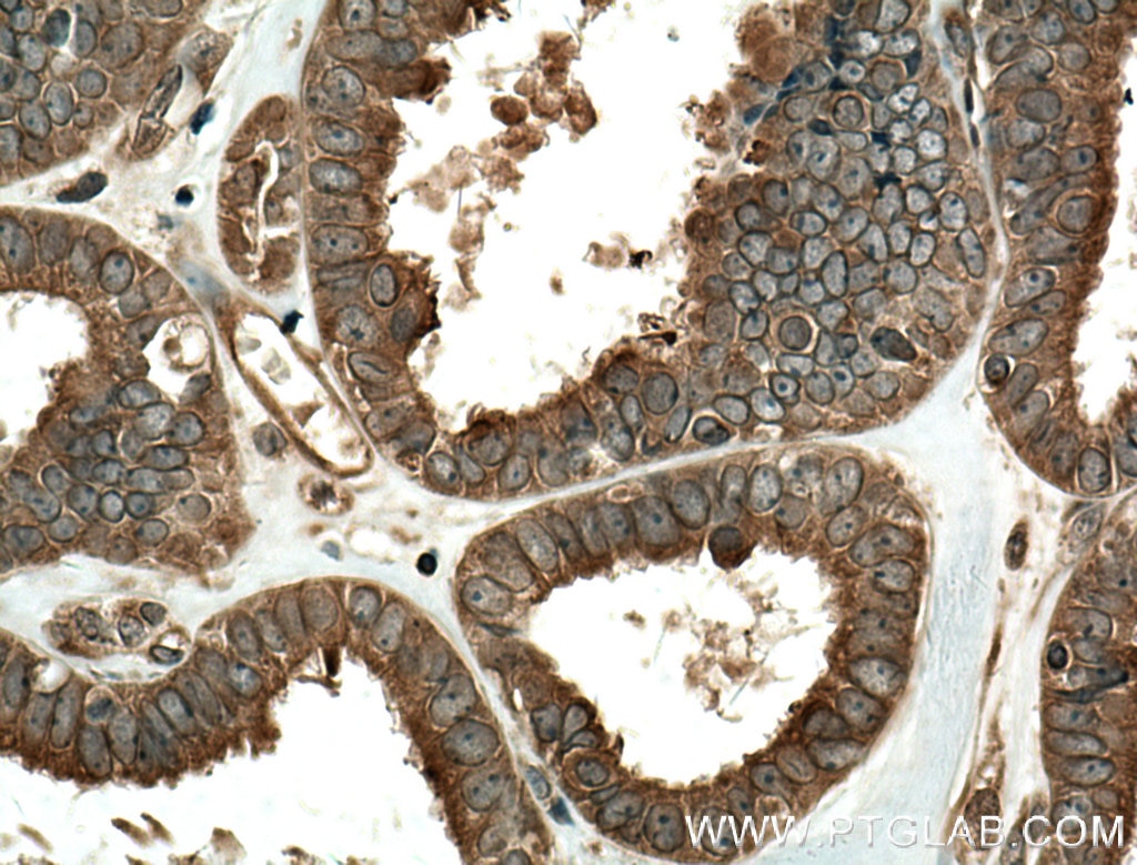 Immunohistochemistry (IHC) staining of human ovary tumor tissue using ENTPD7 Polyclonal antibody (24558-1-AP)