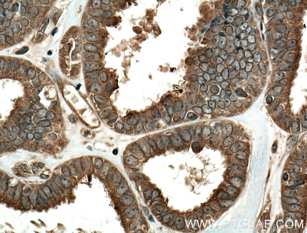 IHC staining of human ovary tumor using 24558-1-AP