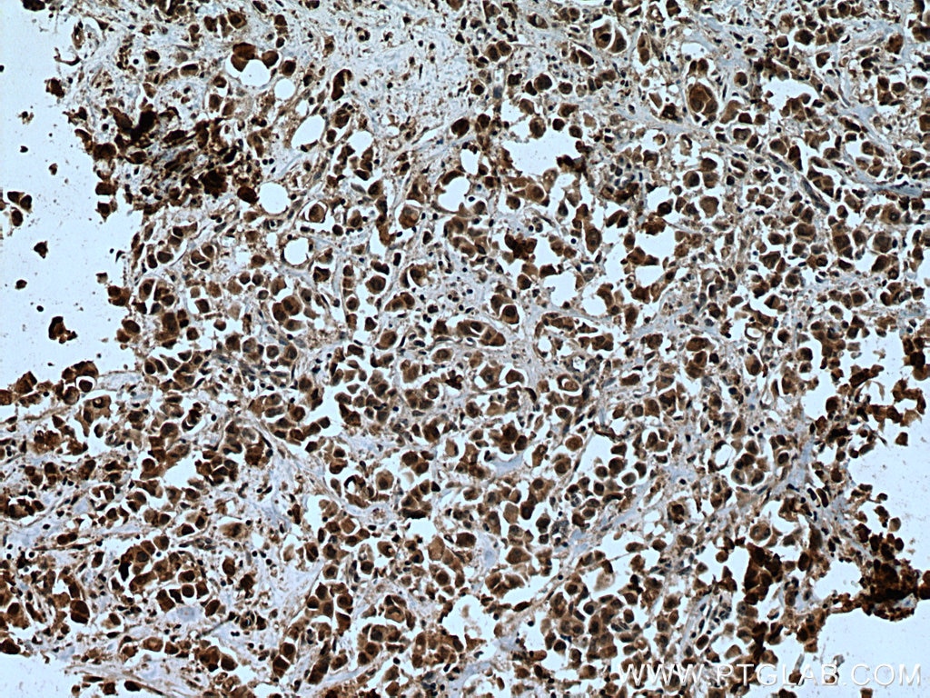 Immunohistochemistry (IHC) staining of human breast cancer tissue using ENY2 Polyclonal antibody (15778-1-AP)