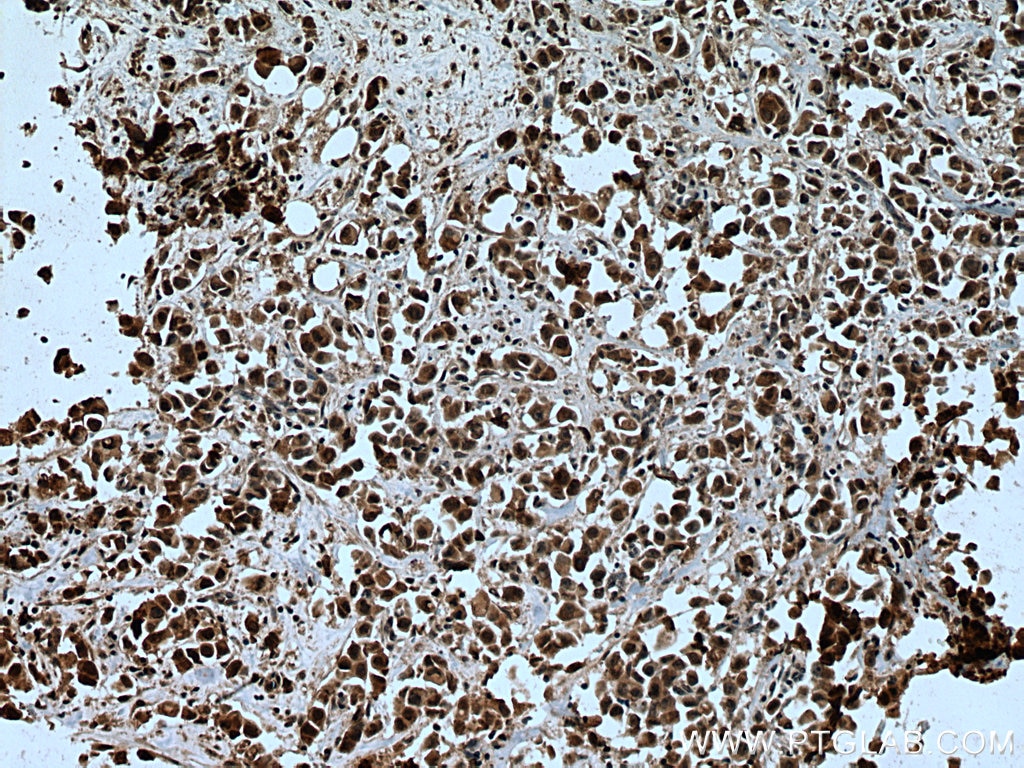 IHC staining of human breast cancer using 15778-1-AP