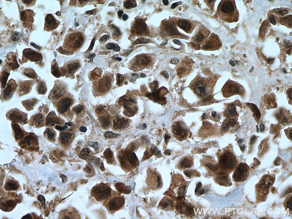 IHC staining of human breast cancer using 15778-1-AP
