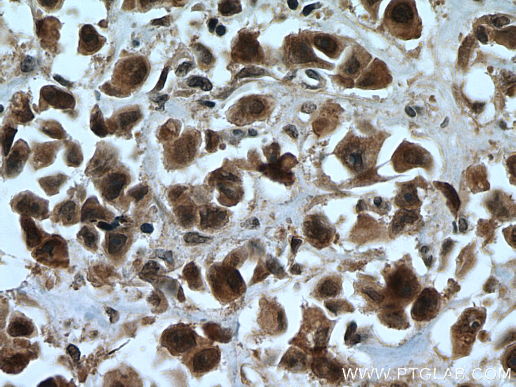 Immunohistochemistry (IHC) staining of human breast cancer tissue using ENY2 Polyclonal antibody (15778-1-AP)