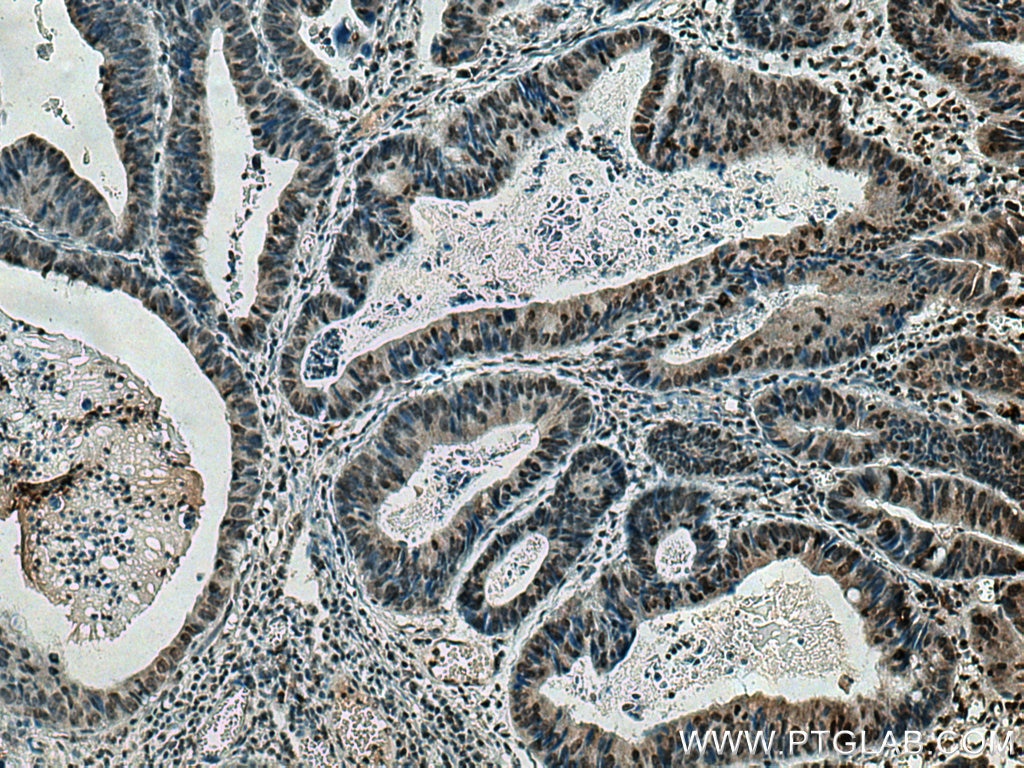 Immunohistochemistry (IHC) staining of human colon cancer tissue using HIF2α/EPAS1 Monoclonal antibody (66731-1-Ig)