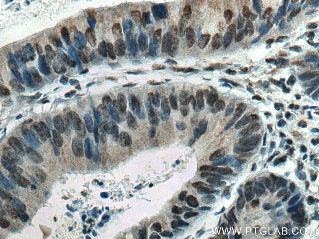 IHC staining of human colon cancer using 66731-1-Ig