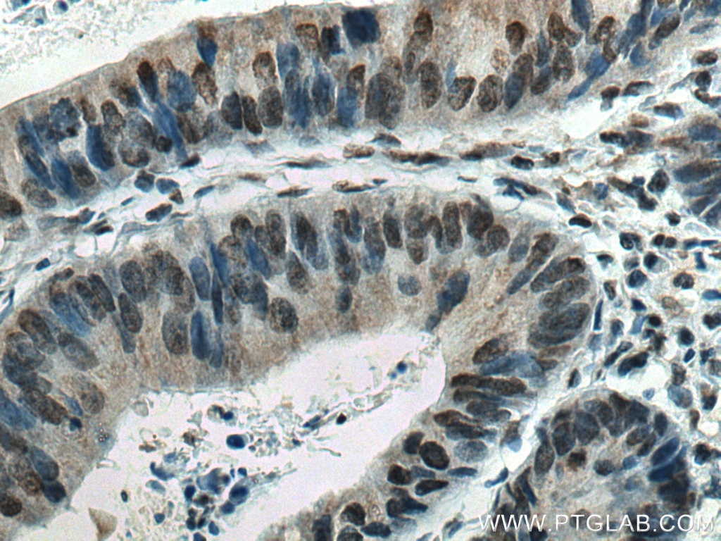 Immunohistochemistry (IHC) staining of human colon cancer tissue using HIF2α/EPAS1 Monoclonal antibody (66731-1-Ig)