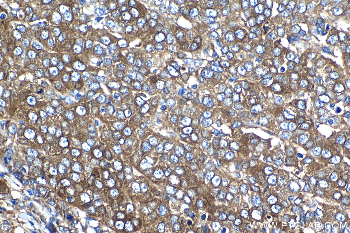 Immunohistochemistry (IHC) staining of human ovary tumor tissue using EPB41L2 Polyclonal antibody (15437-1-AP)