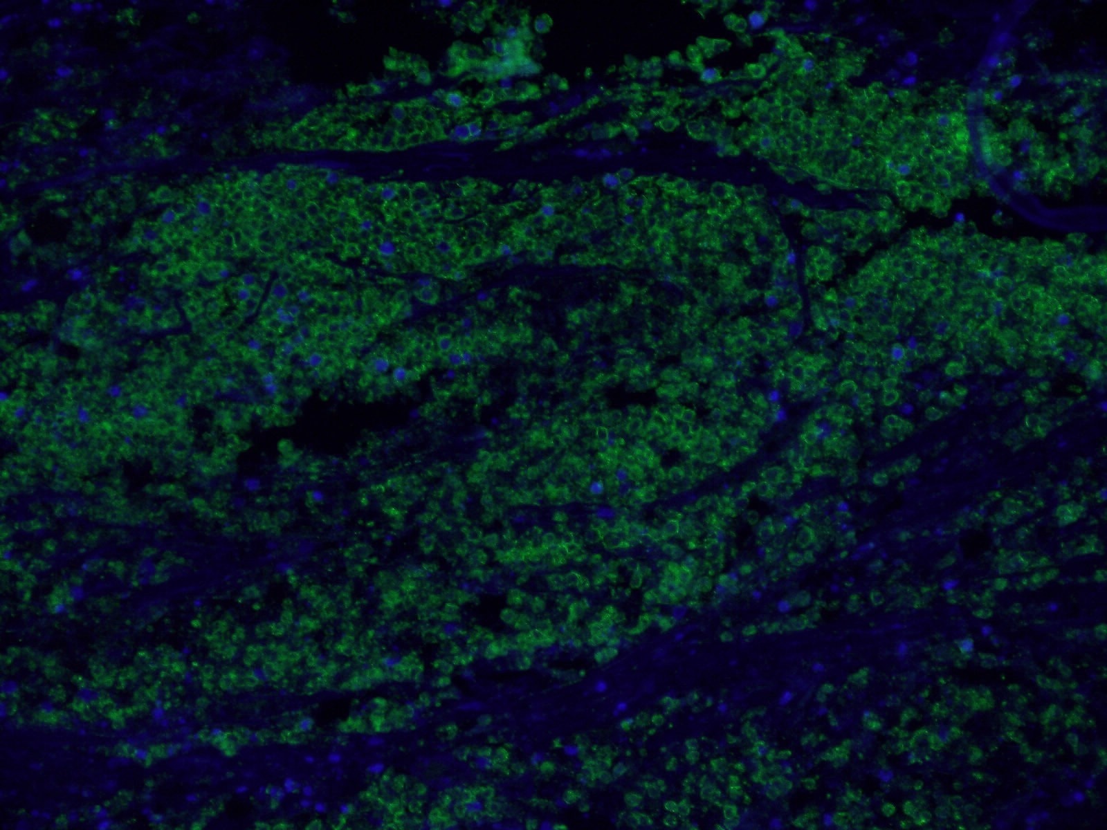 Immunofluorescence (IF) / fluorescent staining of human colon cancer tissue using EPCAM/CD326 Polyclonal antibody (21050-1-AP)