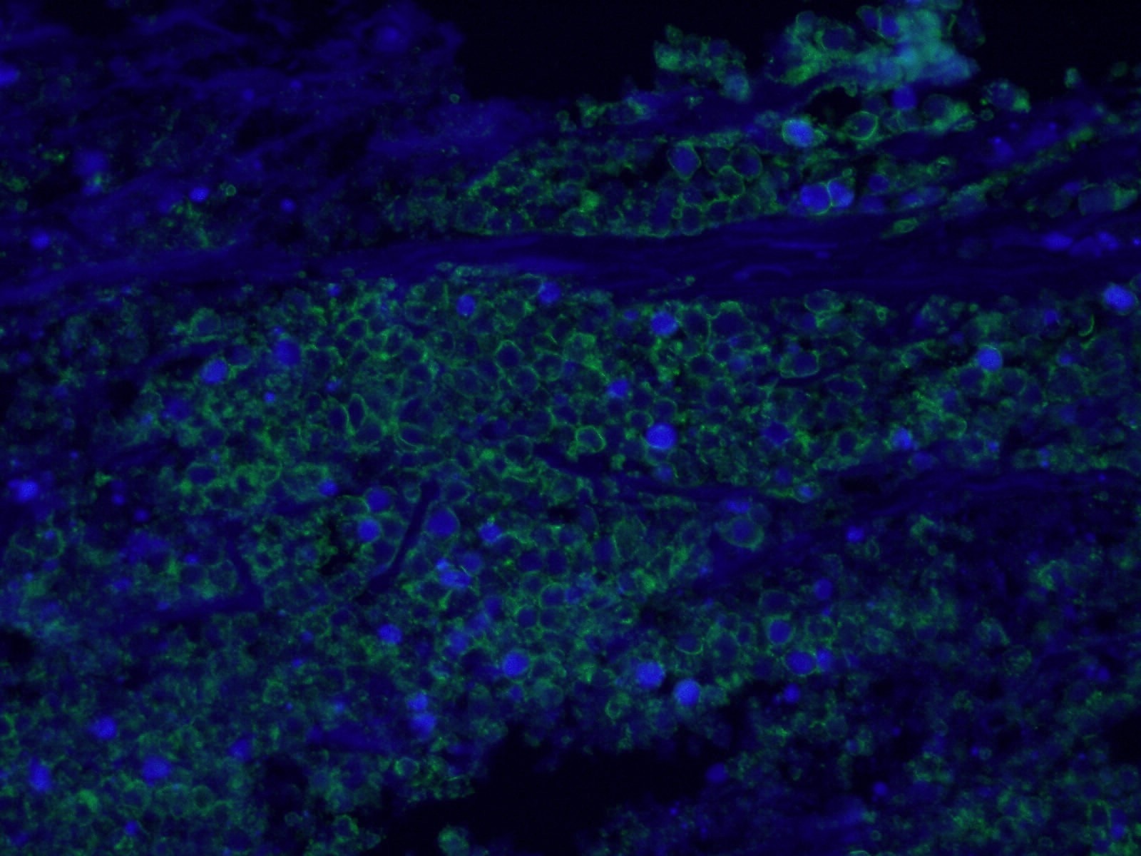Immunofluorescence (IF) / fluorescent staining of human colon cancer tissue using EPCAM/CD326 Polyclonal antibody (21050-1-AP)