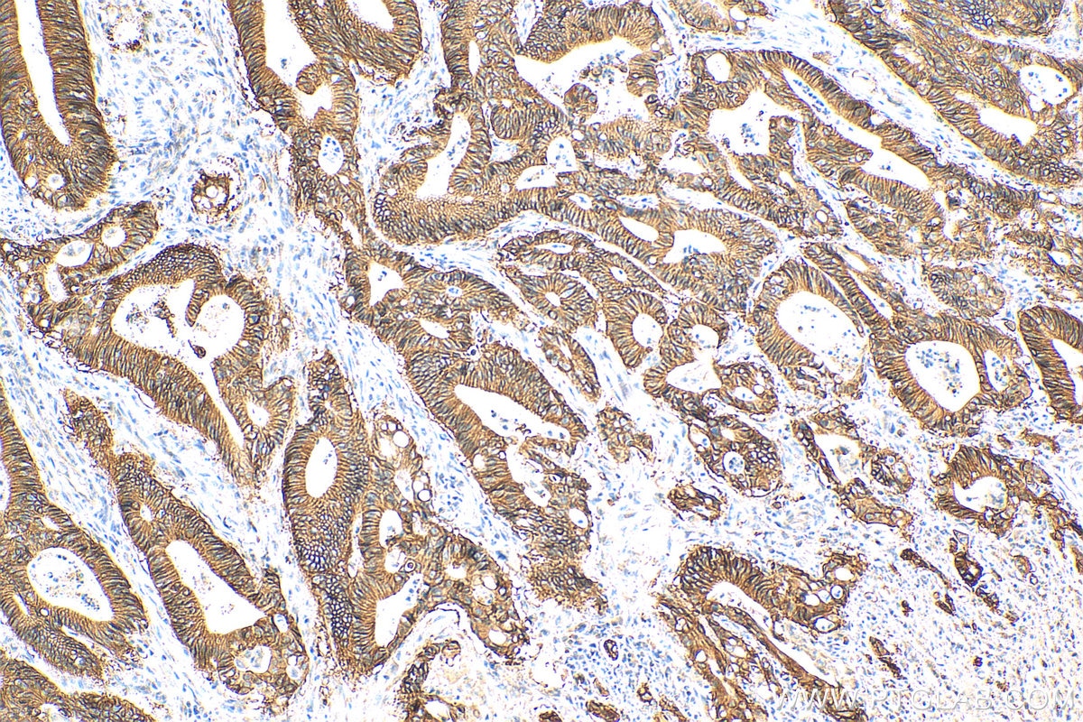 Immunohistochemistry (IHC) staining of human colon cancer tissue using EPCAM/CD326 Polyclonal antibody (21050-1-AP)