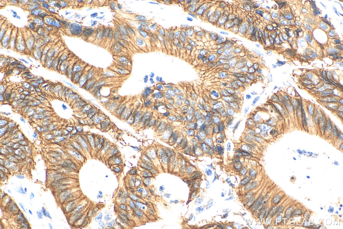 Immunohistochemistry (IHC) staining of human colon cancer tissue using EPCAM/CD326 Polyclonal antibody (21050-1-AP)