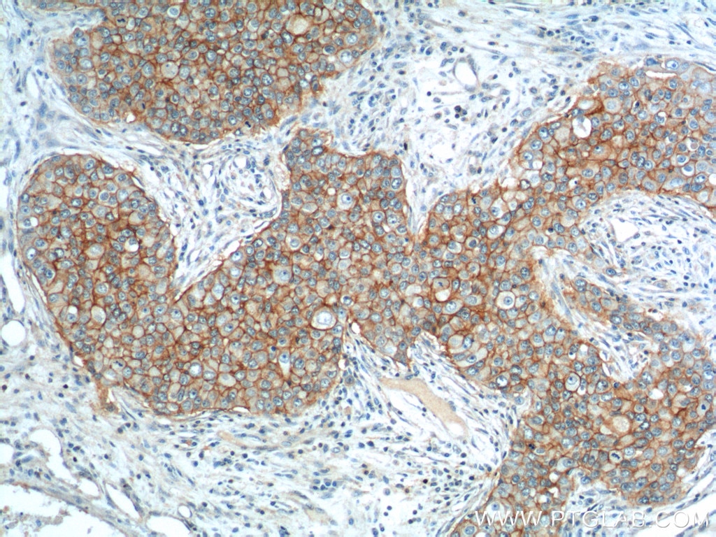 Immunohistochemistry (IHC) staining of human breast cancer tissue using EPCAM/CD326 Polyclonal antibody (21050-1-AP)