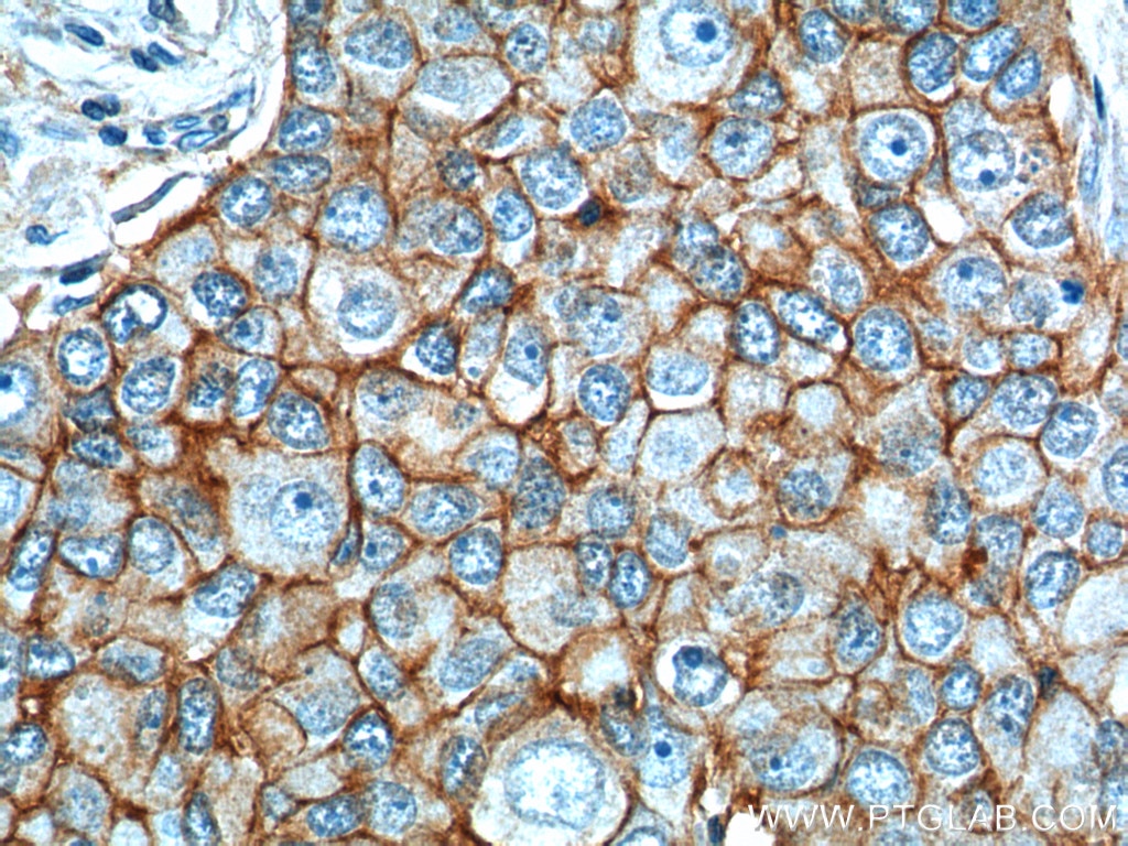 IHC staining of human breast cancer using 21050-1-AP