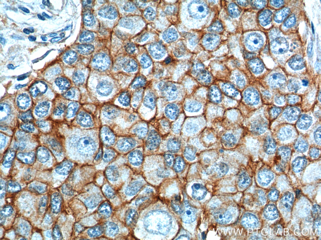 Immunohistochemistry (IHC) staining of human breast cancer tissue using EPCAM/CD326 Polyclonal antibody (21050-1-AP)