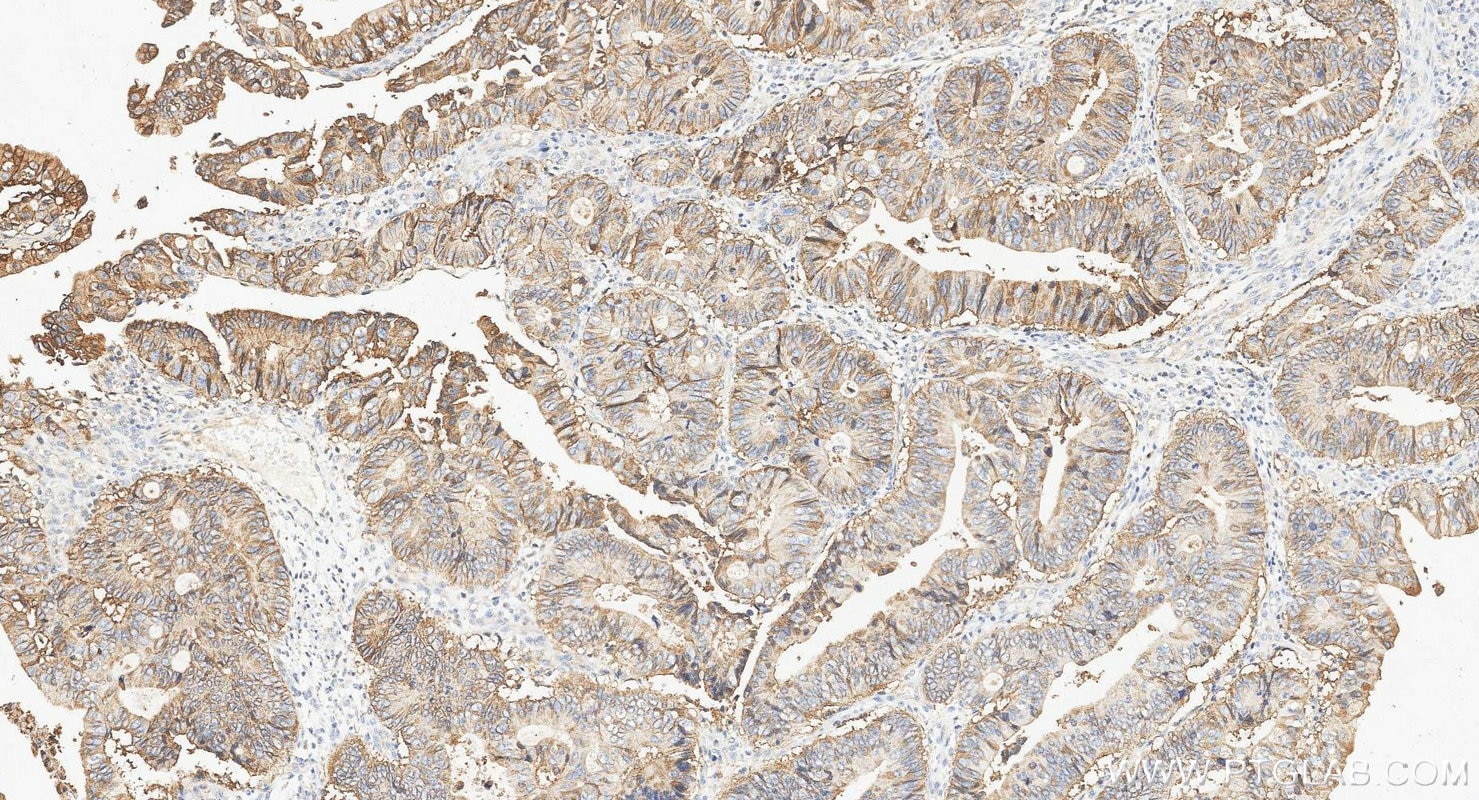 IHC staining of human colorectal cancer using 21050-1-AP Immunohistochemistry (IHC) staining of human colorectal cancer tissue using EPCAM/CD326 Polyclonal antibody (21050-1-AP)
