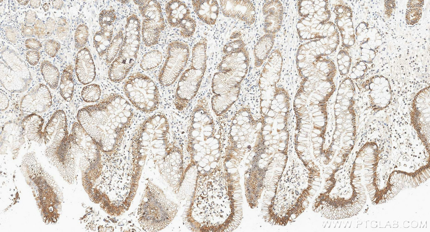 IHC staining of human stomach cancer using 21050-1-AP Immunohistochemistry (IHC) staining of human stomach cancer tissue using EPCAM/CD326 Polyclonal antibody (21050-1-AP)