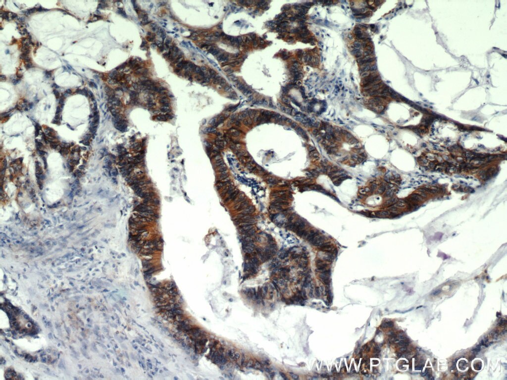 IHC staining of human colon cancer using 21050-1-AP