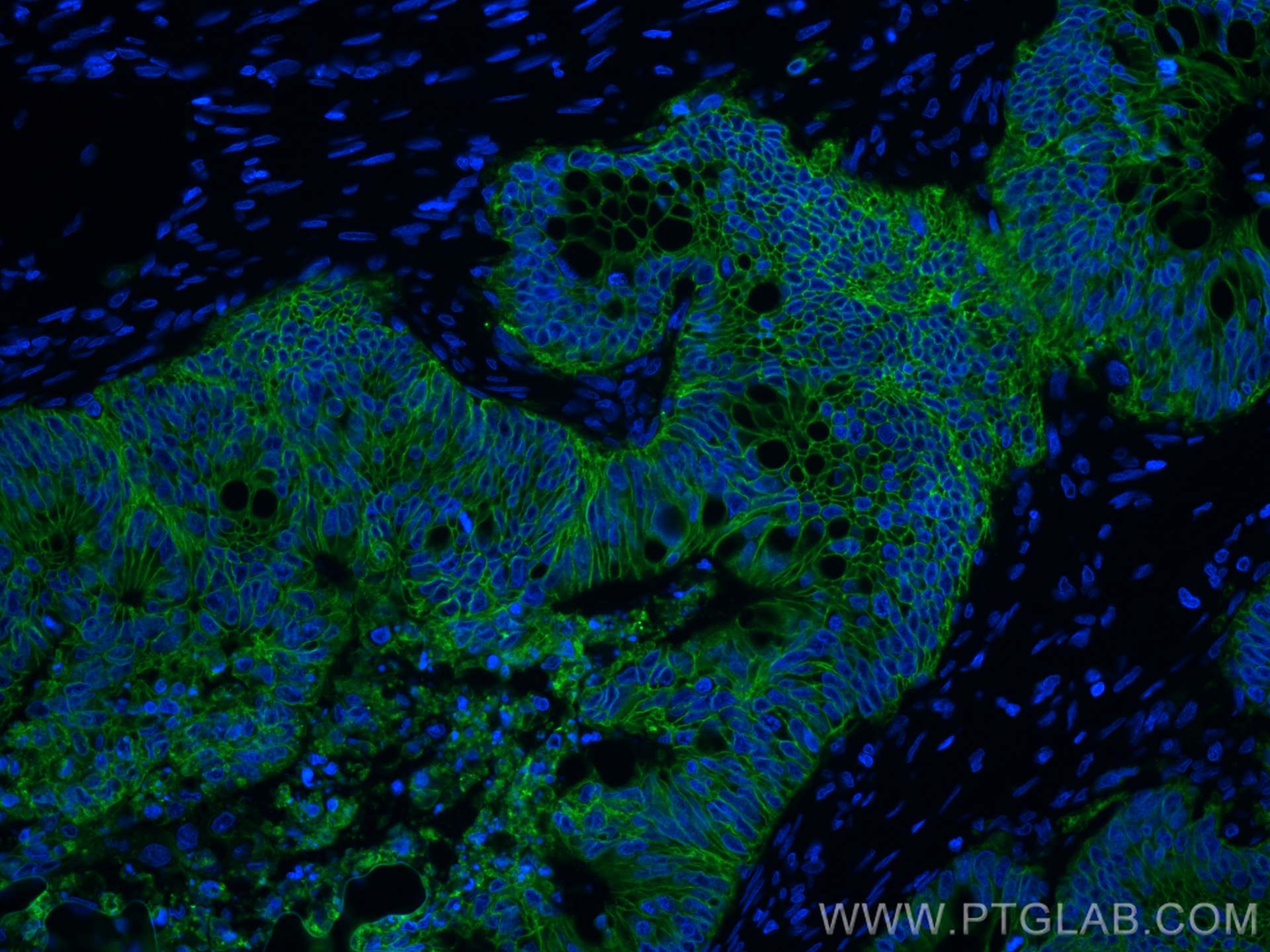 Immunofluorescence (IF) / fluorescent staining of human colon cancer tissue using EPCAM/CD326 Monoclonal antibody (66316-1-Ig)