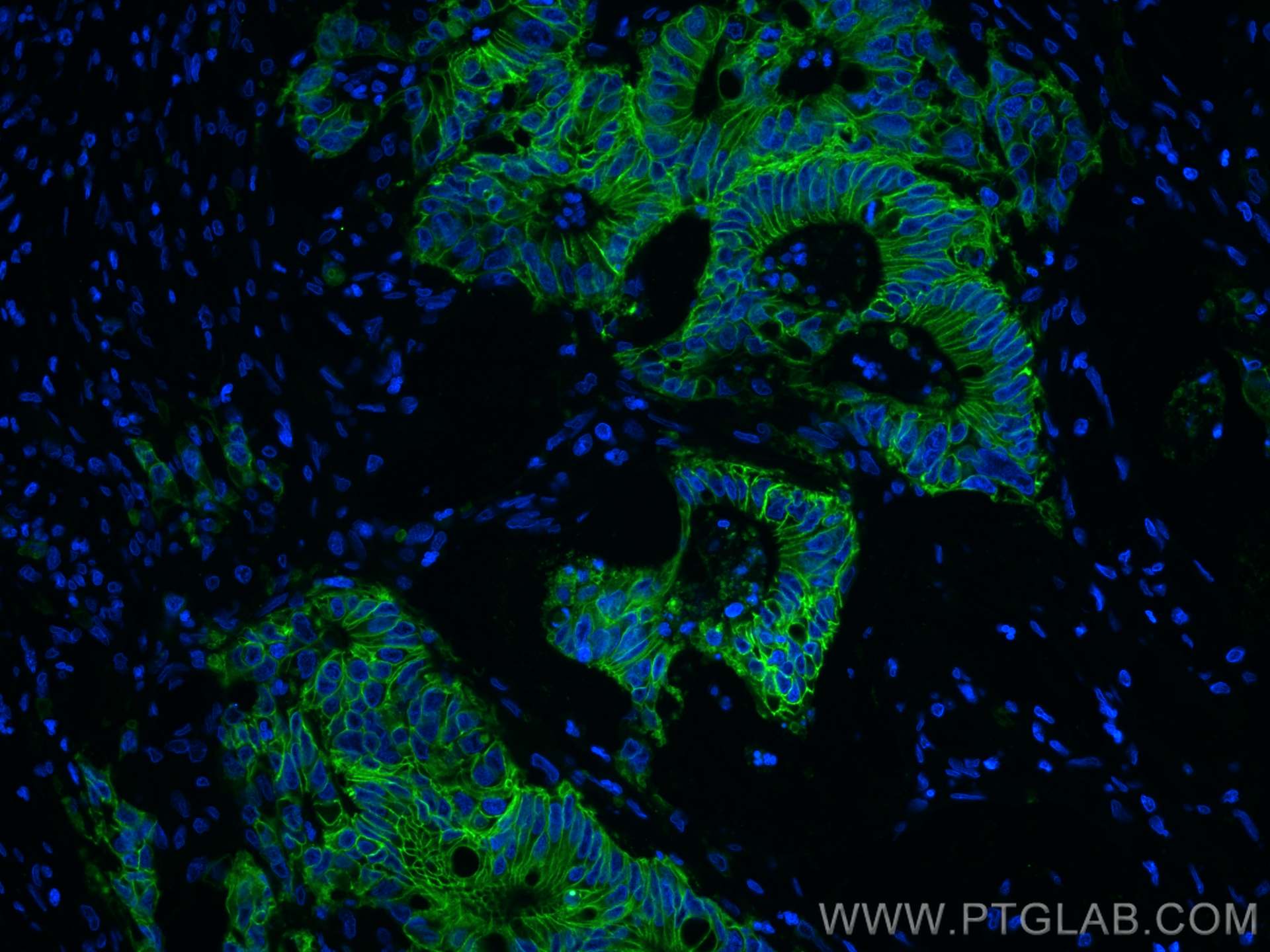 Immunofluorescence (IF) / fluorescent staining of human colon cancer tissue using EPCAM/CD326 Monoclonal antibody (66316-1-Ig)