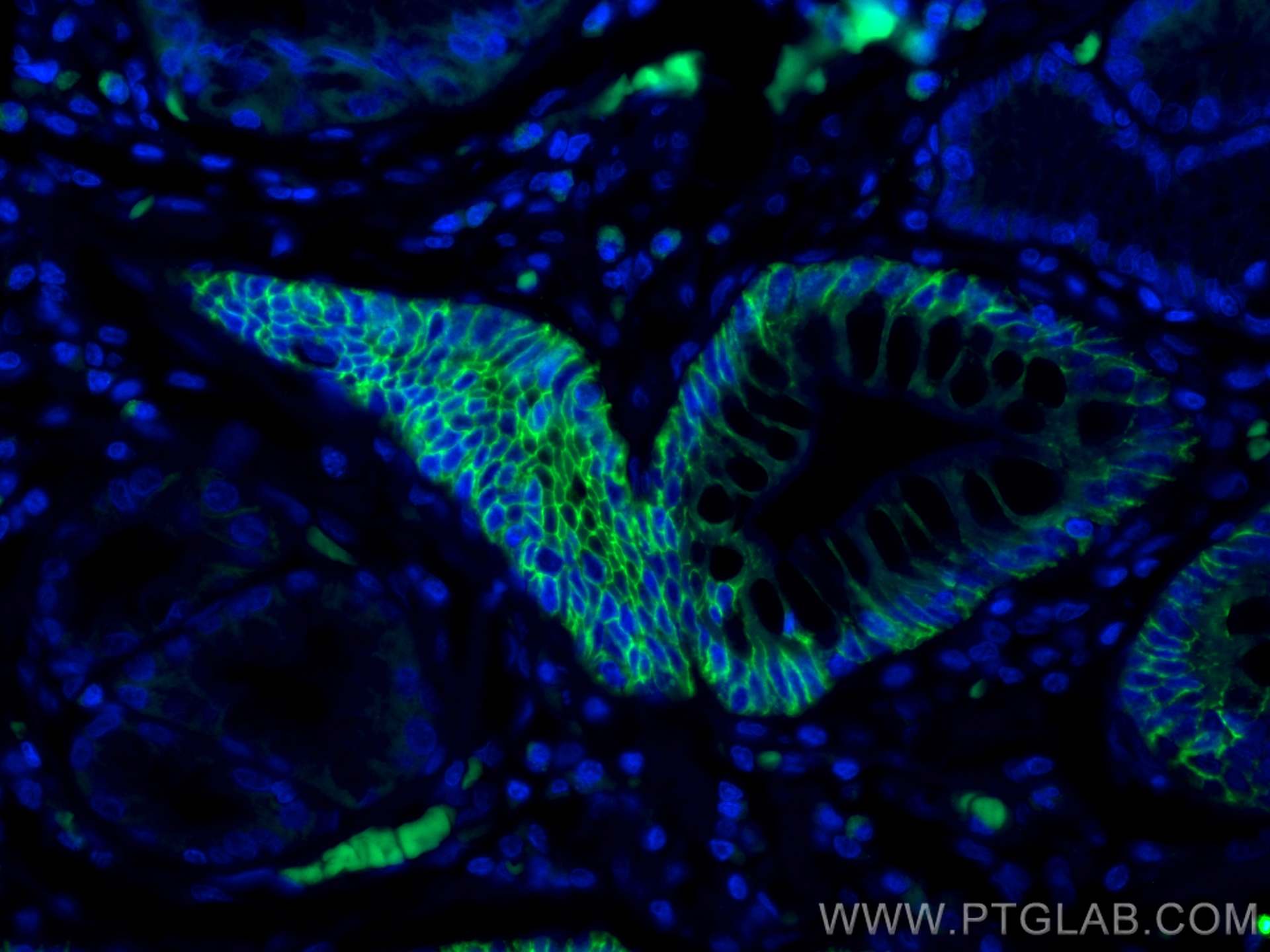 Immunofluorescence (IF) / fluorescent staining of human stomach cancer tissue using EPCAM/CD326 Monoclonal antibody (66316-1-Ig)