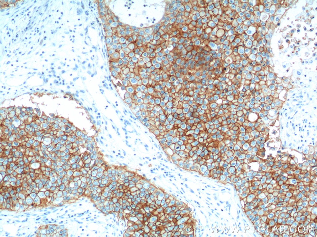 Immunohistochemistry (IHC) staining of human breast cancer tissue using EPCAM/CD326 Monoclonal antibody (66316-1-Ig)