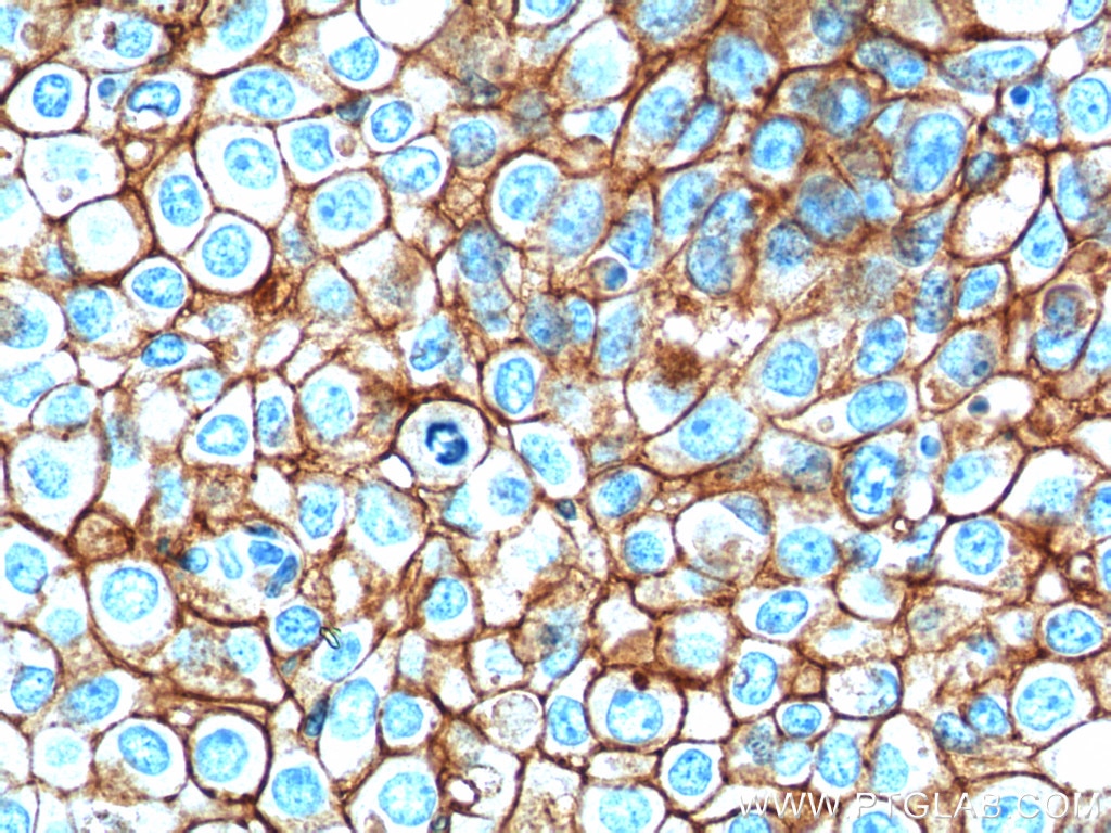 Immunohistochemistry (IHC) staining of human breast cancer tissue using EPCAM/CD326 Monoclonal antibody (66316-1-Ig)