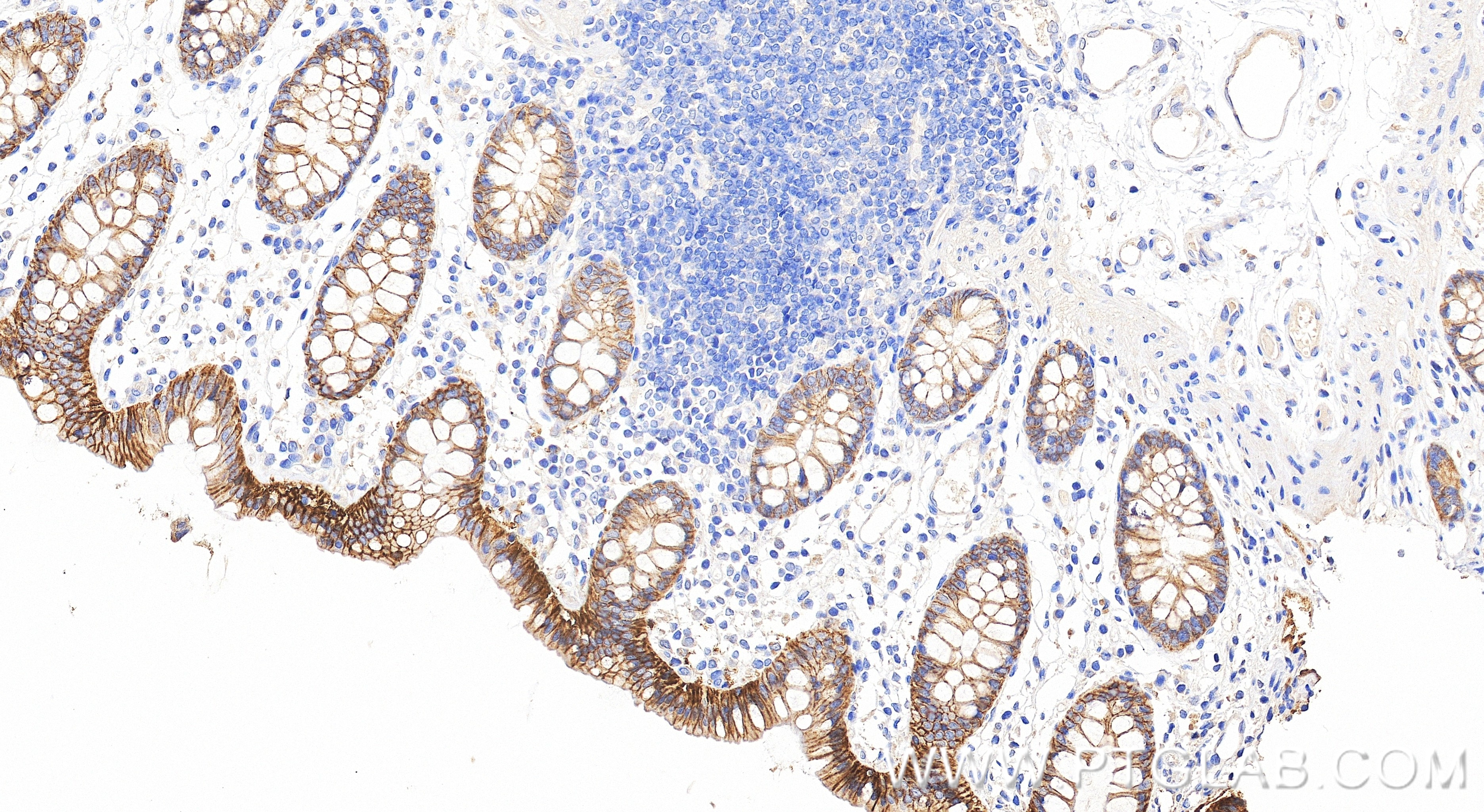 Immunohistochemistry (IHC) staining of human colon tissue using EPCAM/CD326 Recombinant monoclonal antibody (84073-11-RR)