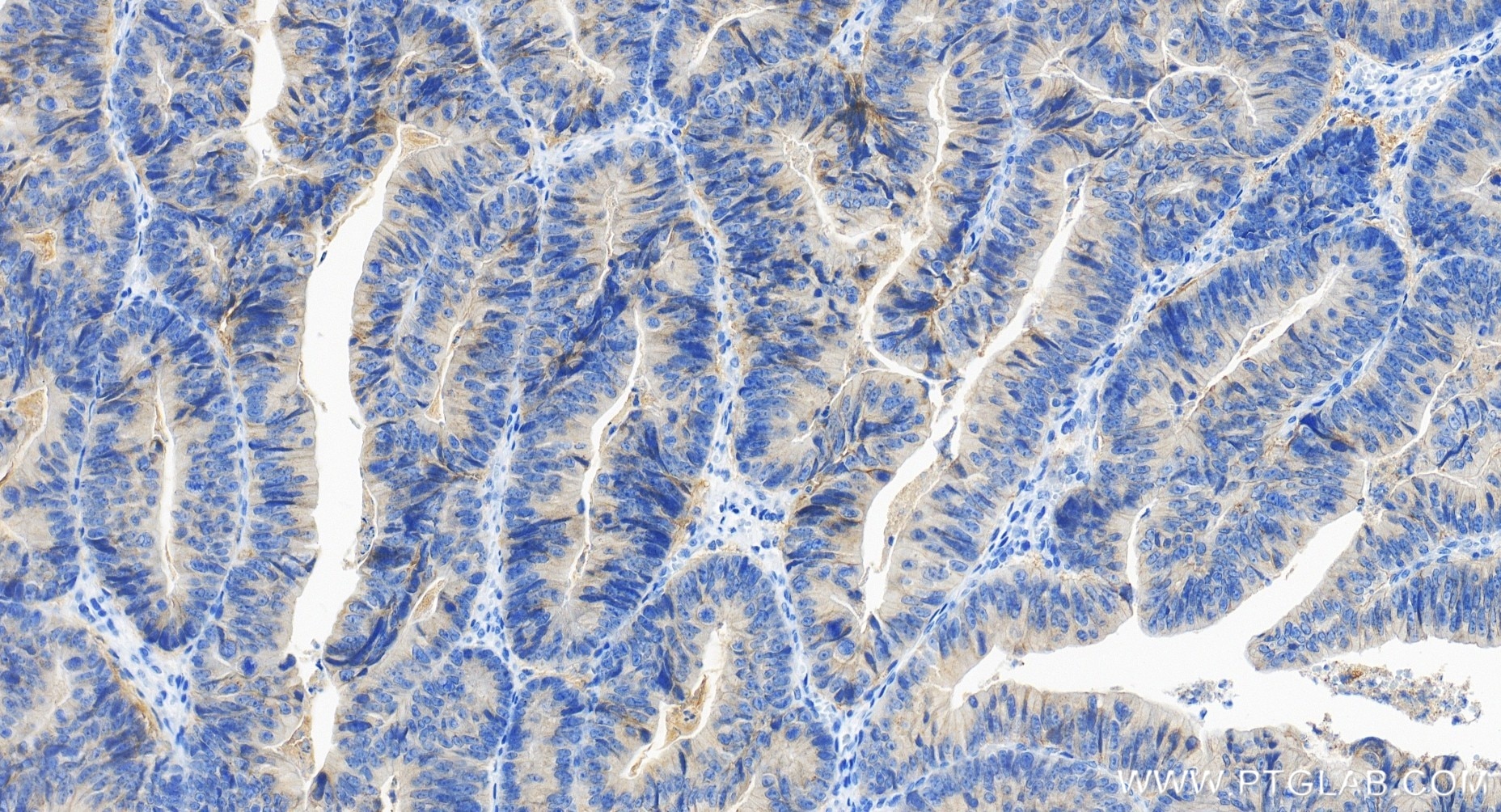 Immunohistochemistry (IHC) staining of human colon cancer tissue using EPCAM/CD326 Recombinant antibody (84073-6-RR)