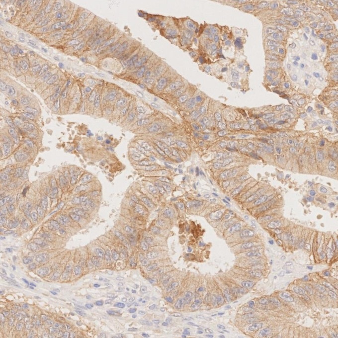 IHC staining of human colorectal cancer using 84073-6-RR Immunohistochemistry (IHC) staining of human colorectal cancer tissue using EPCAM/CD326 Recombinant monoclonal antibody (84073-6-RR)