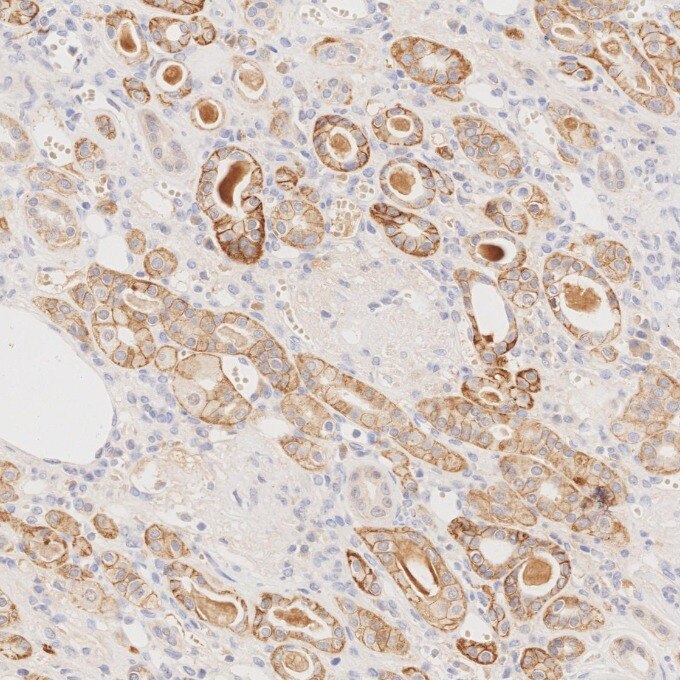 IHC staining of human renal cell carcinoma using 84073-6-RR Immunohistochemistry (IHC) staining of human renal cell carcinoma tissue using EPCAM/CD326 Recombinant monoclonal antibody (84073-6-RR)