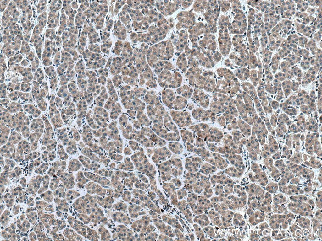 Immunohistochemistry (IHC) staining of human liver cancer tissue using EPHA1-specific Polyclonal antibody (18698-1-AP)
