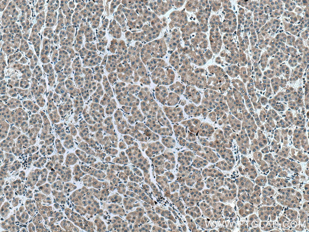 Immunohistochemistry (IHC) staining of human liver cancer tissue using EPHA1-specific Polyclonal antibody (18698-1-AP)