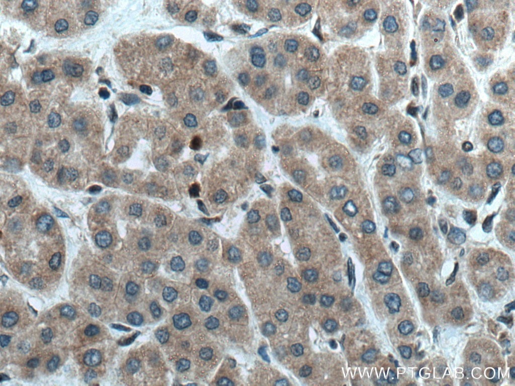 Immunohistochemistry (IHC) staining of human liver cancer tissue using EPHA1-specific Polyclonal antibody (18698-1-AP)