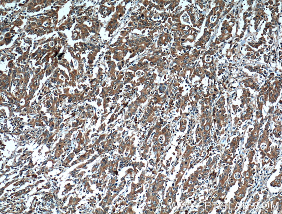 Immunohistochemistry (IHC) staining of human stomach cancer tissue using EPHA1-specific Monoclonal antibody (60155-2-Ig)