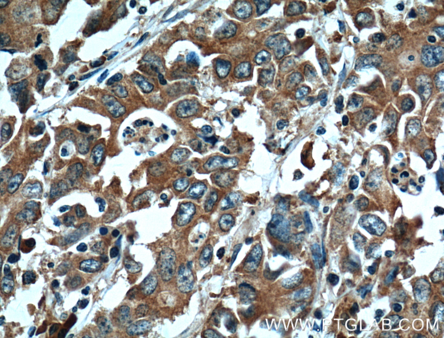 Immunohistochemistry (IHC) staining of human stomach cancer tissue using EPHA1-specific Monoclonal antibody (60155-2-Ig)